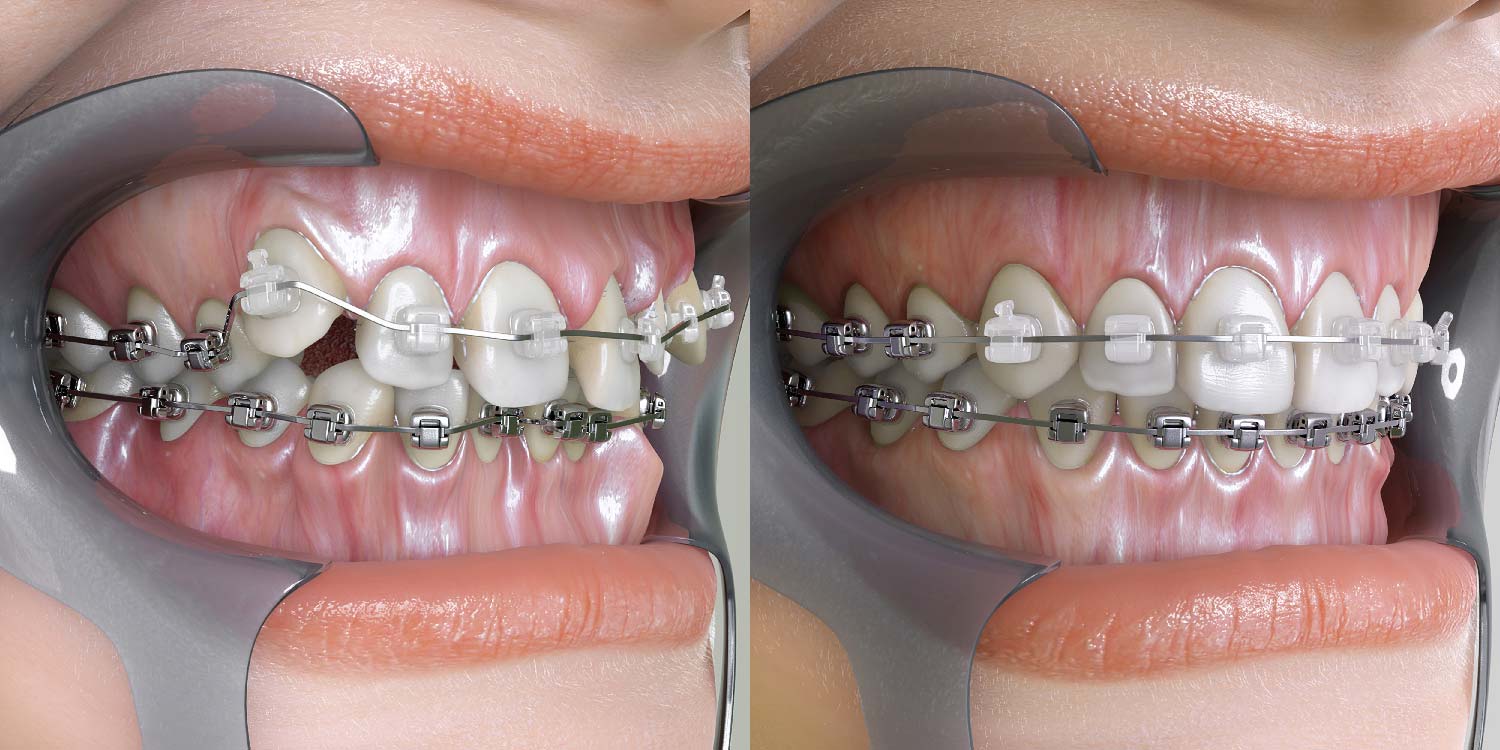 Apparecchio dentale invisibile : denti dritti senza imbarazzo